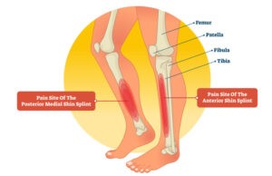 Shin Splints